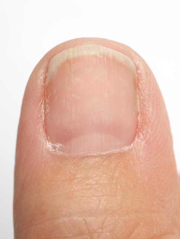 Gesunder Nagel nach Nagelpilz
