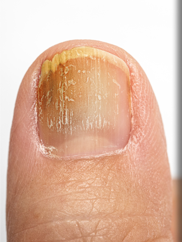 Nagelpilz