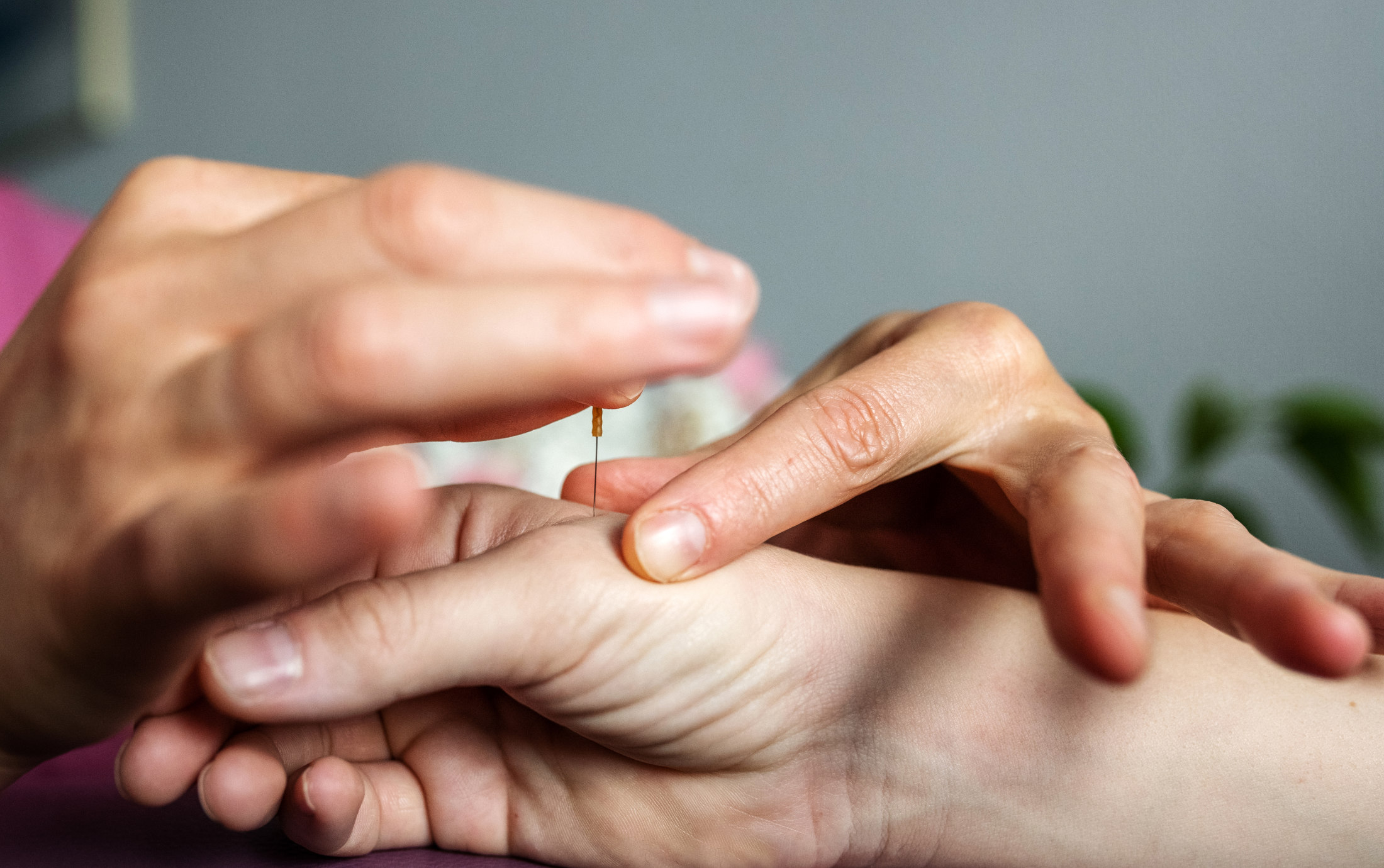 Akupunktur dermatologie Akupunktur dermatologie